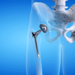 Hip Replacement in Jaipur