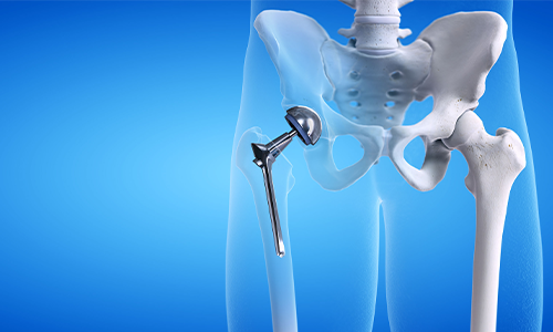 Hip Replacement in Jaipur