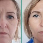 7D Hifu facial treatment