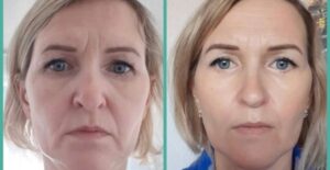 7D Hifu facial treatment
