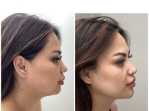 7D Hifu facial treatment