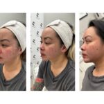 7D Hifu facial treatment