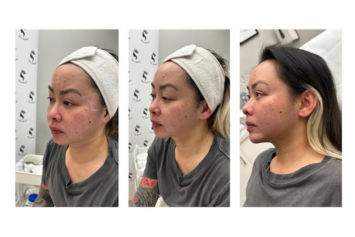 7D Hifu facial treatment