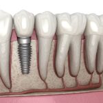 Dental-implant
