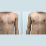 Gynecomastia in dubai