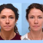 The Benefits of Thread Lift at the Best Aesthetic Clinic in Dubai