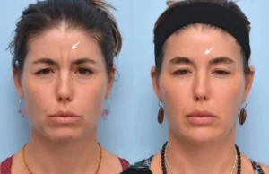 How Safe Is Botox Treatment in Dubai Here’s What You Should Know