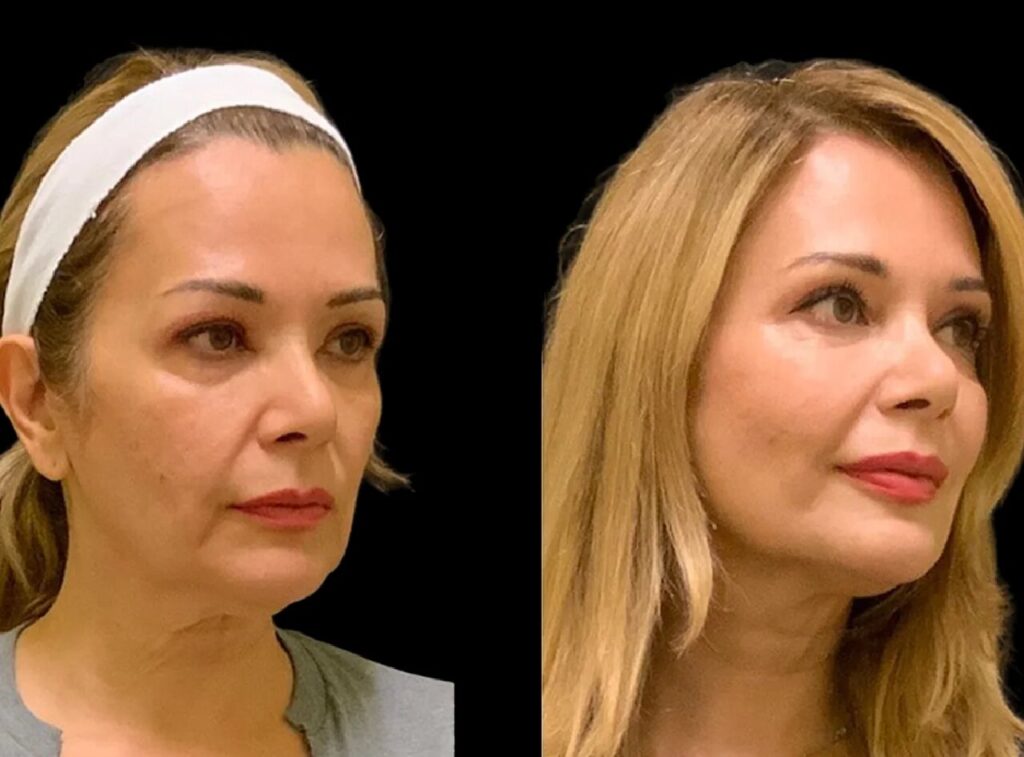H5-Cheek-Fillers (1)