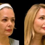 H5-Cheek-Fillers (1)