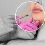 Lipfiller