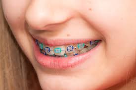 Orthodontist for Children