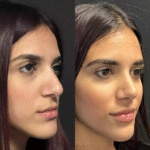 best rhinoplasty surgeon in dubai