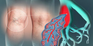 Spider Vein Treatment in Columbus