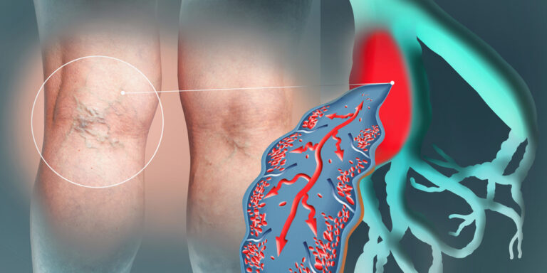Spider Vein Treatment in Columbus