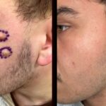 Everything You Need to Know About Sebaceous Cyst Removal in London