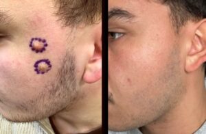 Everything You Need to Know About Sebaceous Cyst Removal in London