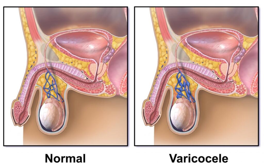preventing varicocele