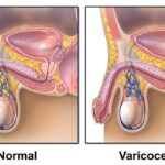 preventing varicocele