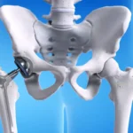 Hip Replacement Surgery in India: Expert Care and Affordable Solutions