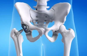 Hip Replacement Surgery in India: Expert Care and Affordable Solutions