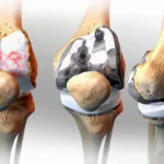 Best Knee Replacement Surgeon in Jaipur