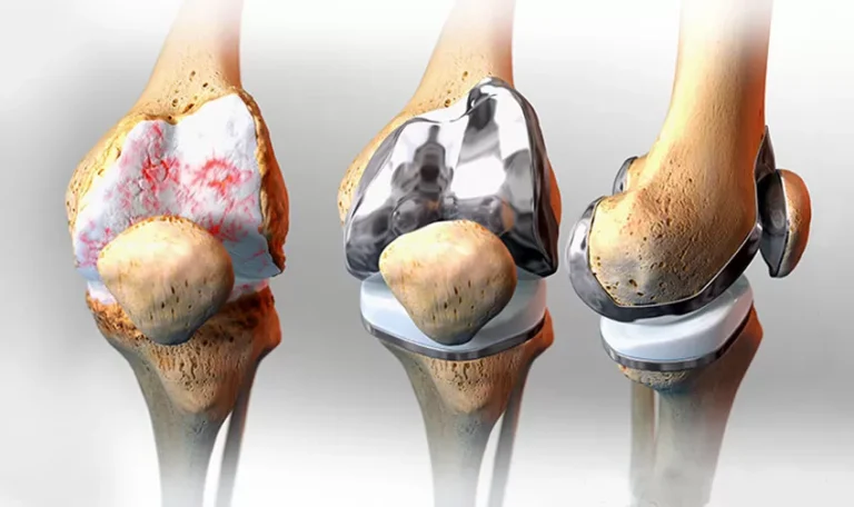 Best Knee Replacement Surgeon in Jaipur