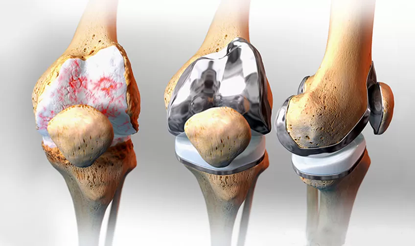 Best Knee Replacement Surgeon in Jaipur