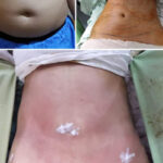liposuction cost in pakistan