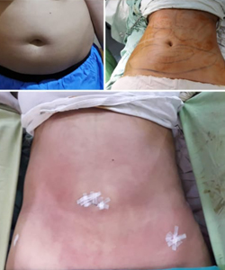 liposuction cost in pakistan