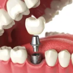 impianto dentale a Tirana / miglior clinica dentale albania