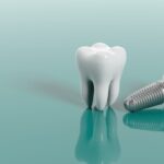 Dental Implants Hampshire