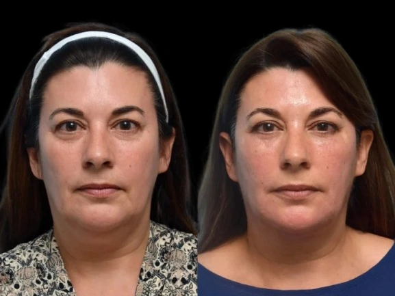 Best Aesthetic Clinic in Dubai for Dark Circles Treatment: Comparing Chemical Peels and Other Alternatives