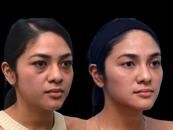 Dark Circles Treatment in Dubai: How Effective Are Topical Retinoids in Reducing Dark Circles