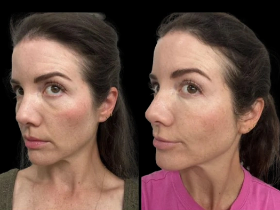 dark circles treatment