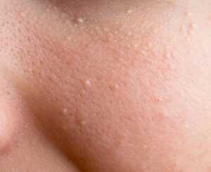 Best home products for large pore treatment