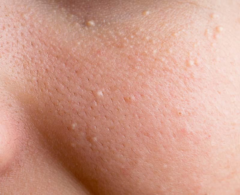 Best home products for large pore treatment