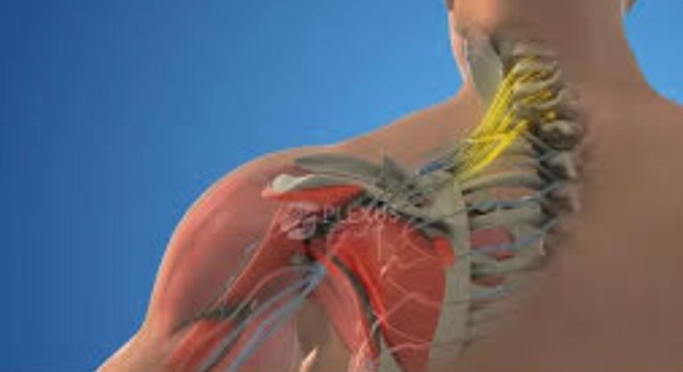 Brachial Plexus Treatment image