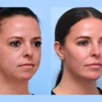 How the Best Aesthetic Clinic in Dubai Ensures Safe Thread Lift Procedures