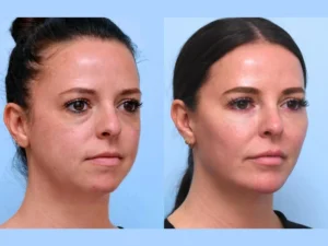 How the Best Aesthetic Clinic in Dubai Ensures Safe Thread Lift Procedures