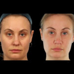 Under Eye Fillers in Dubai