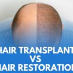 Hair transplant vs hair restoration