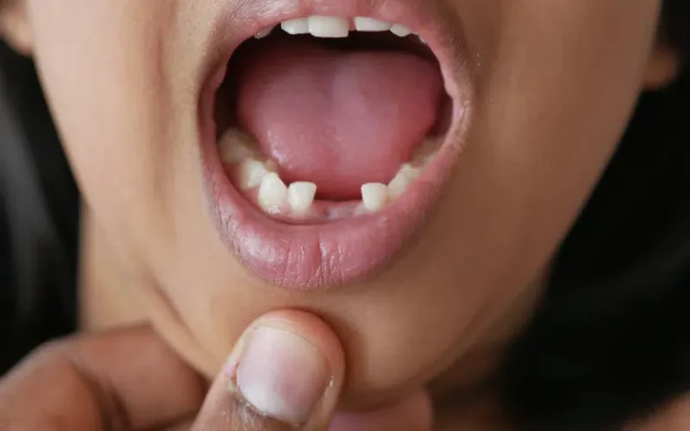 Knocked-out-tooth