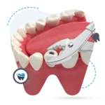wisdom teeth extraction perth