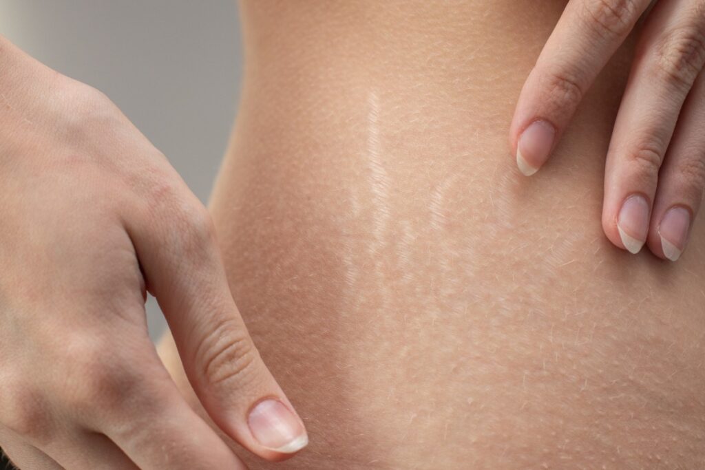 Stretch Marks Removal: Solutions You Can Trust