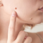 Warts Removal Surgery for Genital Areas: Safe