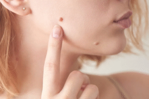 Warts Removal Surgery for Genital Areas: Safe