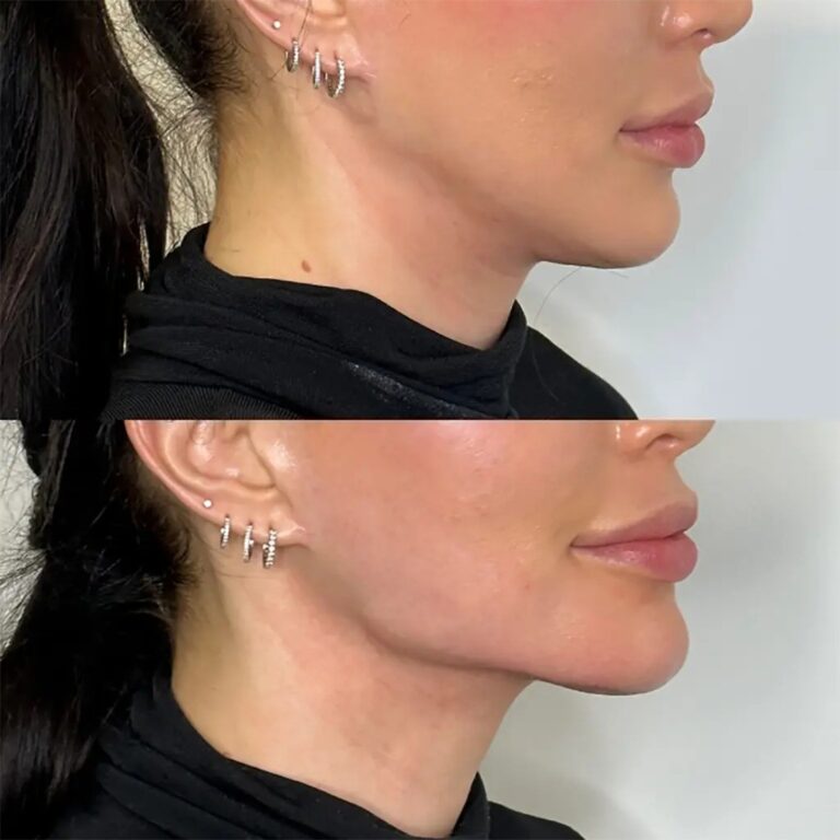 jawline fillers in dubai