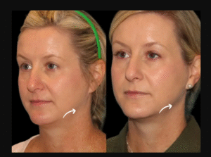 sculptra fillers in dubai