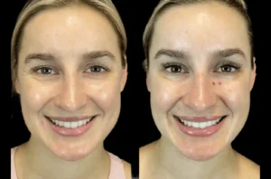 Botox in dubai