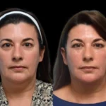3-Dark-Circles-Treatment